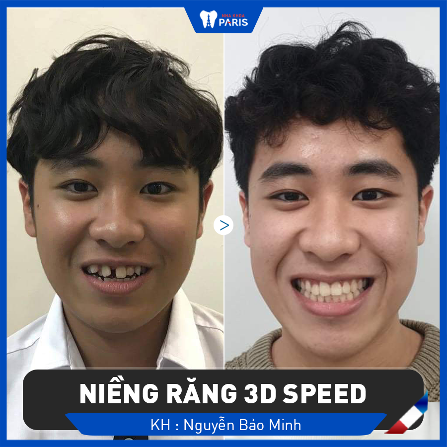 Khách hàng Thu Trang ( 12 tuổi, Hải Phòng ) răng khấp khểnh, cắn ngược sau 6 tháng niềng răng mắc cài kim loại thường
