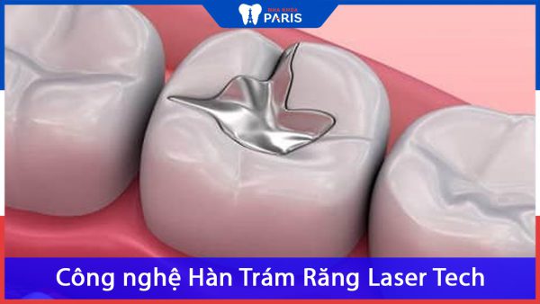 Công nghệ Hàn Trám Răng Laser Tech – Tái tạo răng chỉ trong 30 Phút