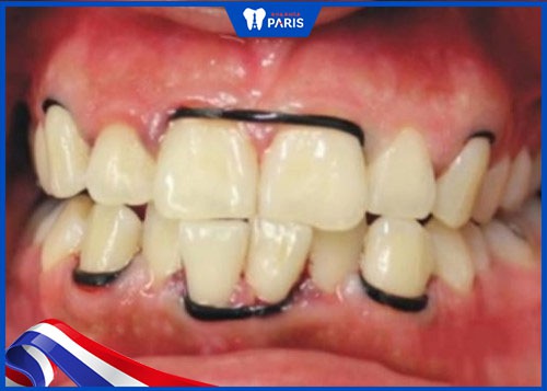 Hậu quả chữa Răng Hô Tại Nhà