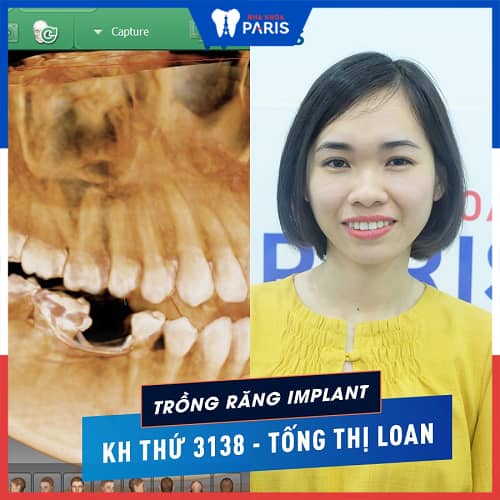 trồng răng implant 4s 