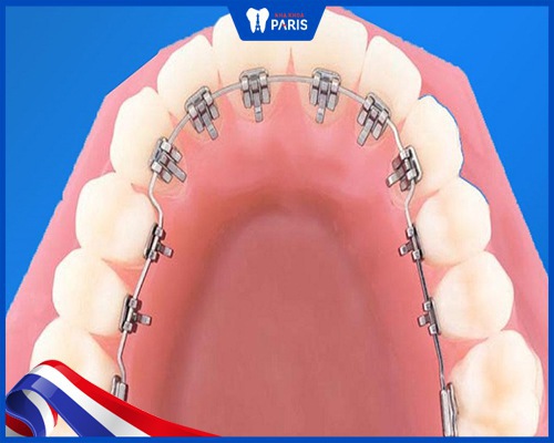 Với khí cụ truyền thống điểm hạn chế chính là khó vệ sinh bởi mắc cài dây cung được gắn ở sau răng khó quan sát.