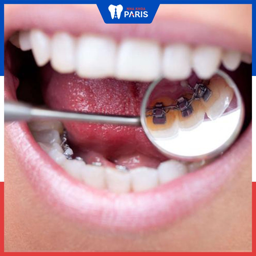 Niềng răng mắc cài trong được thực hiện để nắn chỉnh răng mọc lệch, sai khớp cắn, răng hô, móm, thưa… nhờ hệ thống dây cung và mắc cài.