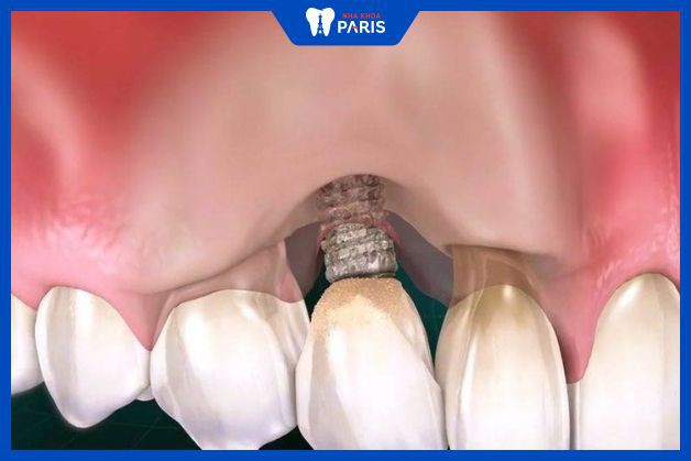 Với lượng xương hàm thấp thì rất khó cắm chặt răng implant