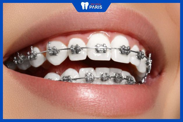 Răng dịch chuyển khi niềng tiêu xương hàm nhưng sẽ hồi phục lại