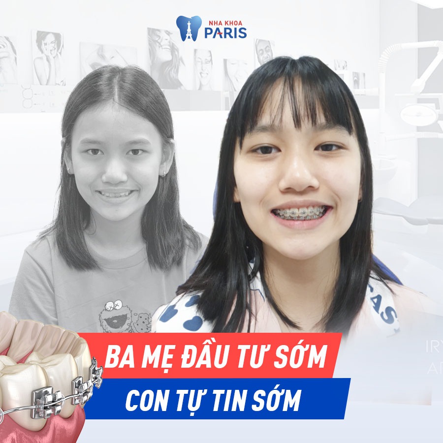 Khách hàng Nguyễn Thị Miền (25 tuổi, TP HCM) răng khấp khểnh, cười hở lợi... Kết quả niềng răng sau 18 tháng với công nghệ niềng răng 3D Speed chuẩn Pháp