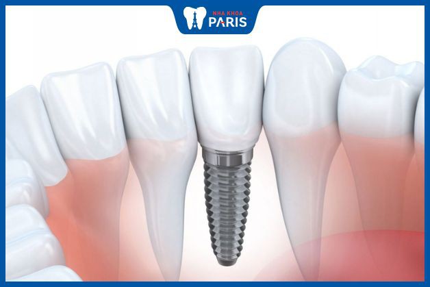 Implant là phương pháp phục hình răng nanh hiệu quả