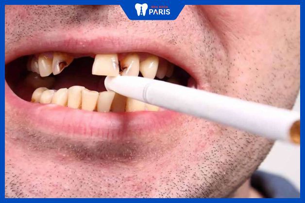 Thói quen hút thuốc lá gây ra rụng răng