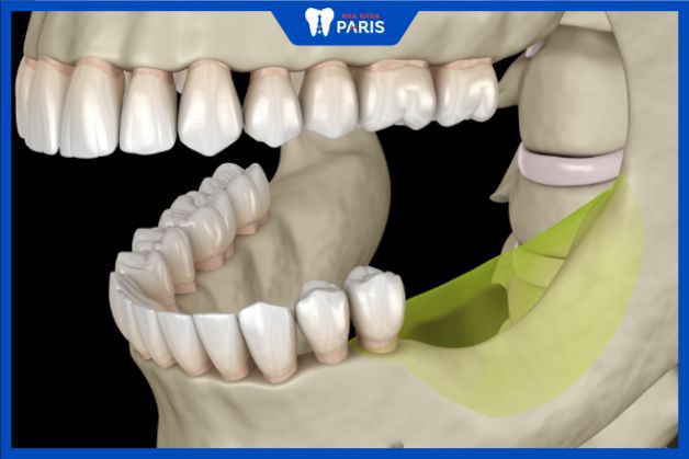trồng răng nguyên hàm với Implant ngăn chặn tiêu xương răng