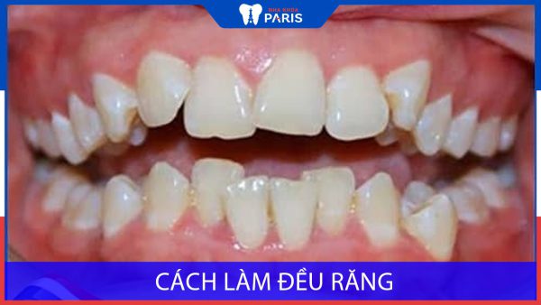 Cách làm hàm răng đều sau khi niềng răng, một số lưu ý quan trọng