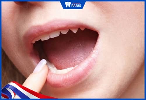 Khô miệng do lười uống nước gây nên ung thư răng