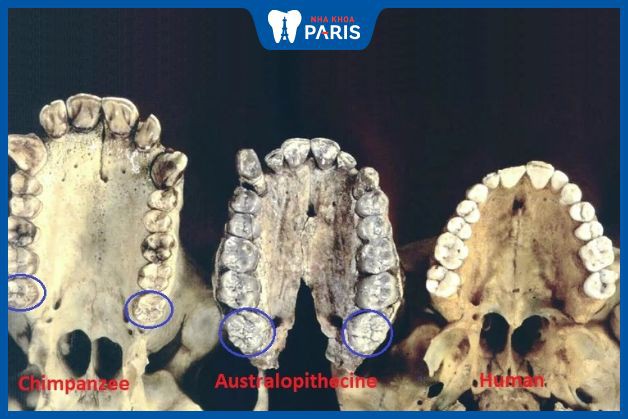 Răng khôn tiêu biến trong quá trình tiến hóa