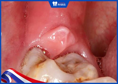 nhận biết viêm lợi trùm răng khôn khi mang thai từ sưng nướu ở trong cùng
