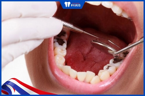 Sâu răng dẫn tới hôi miệng