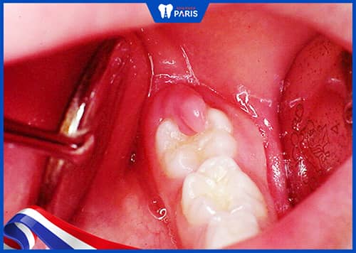 triệu chứng khi bị sưng lợi răng hàm