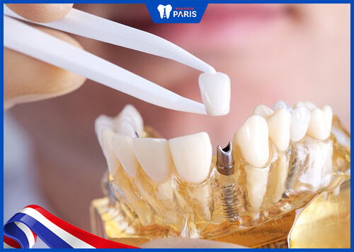 Khôi phục răng nanh bằng phương pháp trồng răng Implant