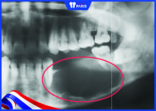  trồng răng nguyên hàm với Implant ngăn chặn tiêu xương răng