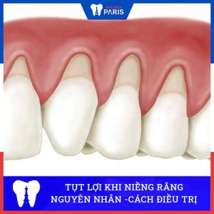 Tụt lợi khi niềng răng: Nguyên nhân, Dấu Hiệu & Cách Điều Trị Hiệu Quả