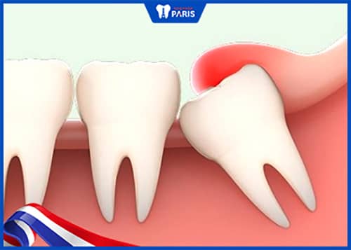 Nguyên nhân gây ra viêm lợi trùm do răng khôn mọc lệch