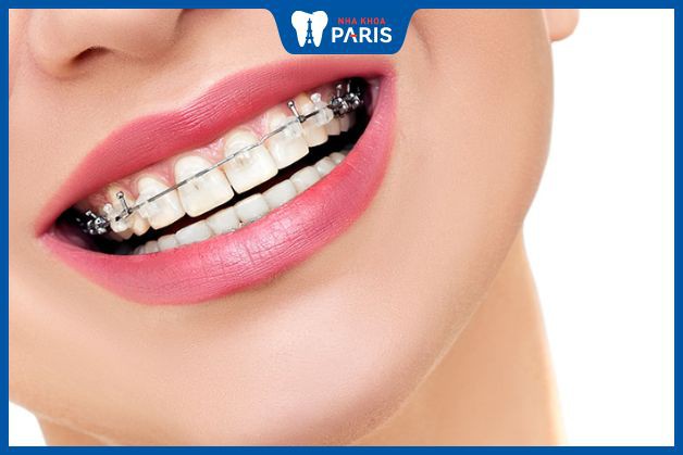 Các yếu tố ảnh hưởng đến khả năng niềng răng khi đã bọc răng sứ