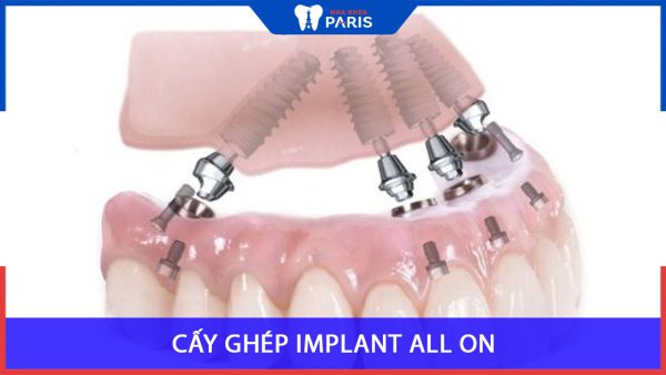 Cấy Ghép Implant All On 4, all on 6 toàn hàm, Giải pháp trồng răng
