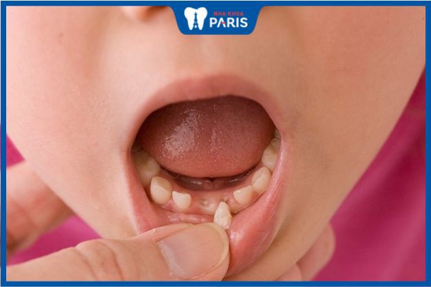 Nhổ răng sữa không viêm chỉ cần vệ sinh cẩn thận