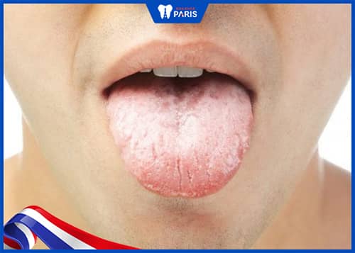 vệ sinh lưỡi giúp giảm tình trạng lưỡi trắng