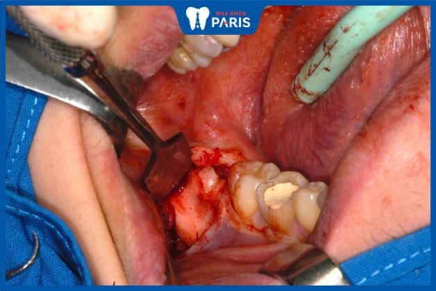 Nhổ răng chỉ ảnh hưởng nếu bác sĩ tay nghề kém gây biến chứng