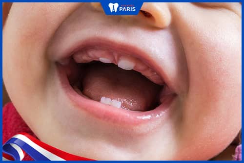 răng nanh ở trẻ mọc trước răng cửa