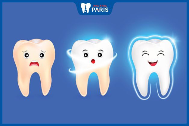 Tráng men răng bổ sung lớp bảo vệ cho răng