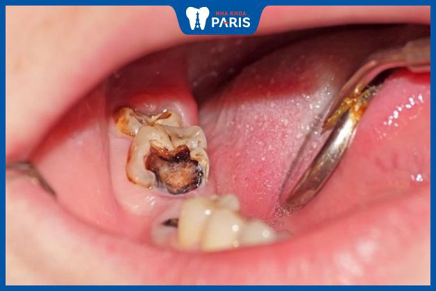 Răng cấm bị sâu nặng cần phải nhổ bỏ