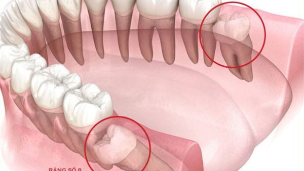 Răng khôn mọc lệch: Nguy hiểm và biến chứng thường gặp