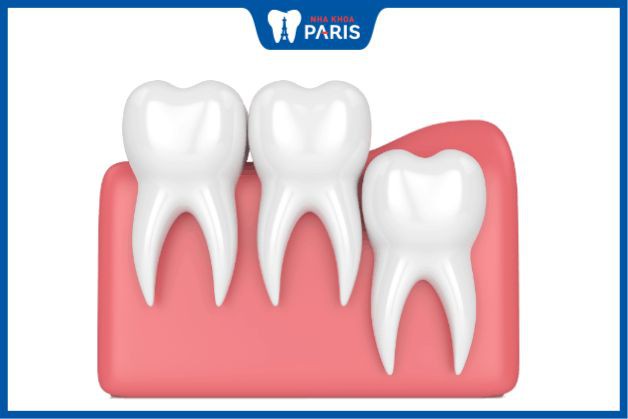 Hạn chế tác động vào khu vực nhổ răng khôn