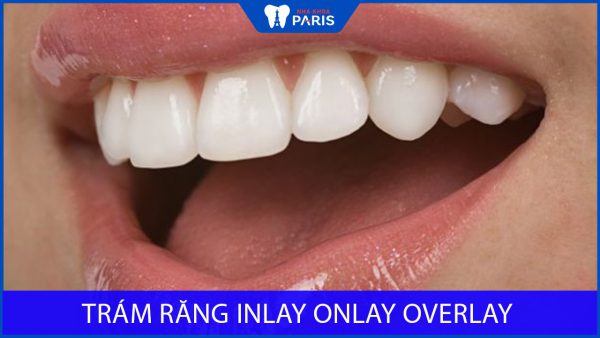 Trám răng Inlay Onlay Overlay là gì? Vì sao giá lại đắt ngang răng sứ?