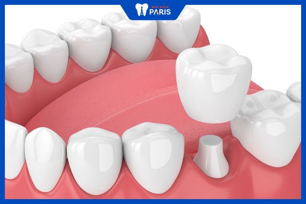 Răng hàm cần loại sứ bền chắc hơn