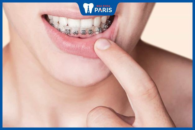 Niềng răng một hàm dưới mất bao lâu?
