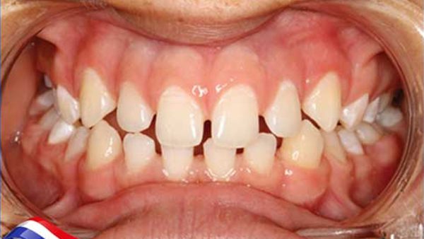 Răng hàm dưới thưa: Tình trạng và cách khắc phục