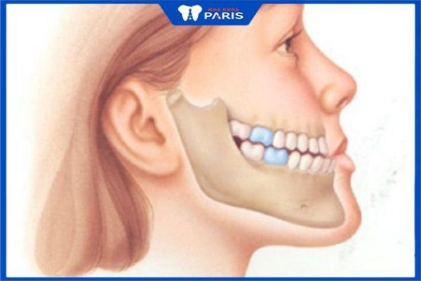 Cách Phân biệt răng món và hàm móm: Một số tiêu chí rõ ràng