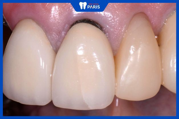Răng sứ kim loại bị đen cả chân răng