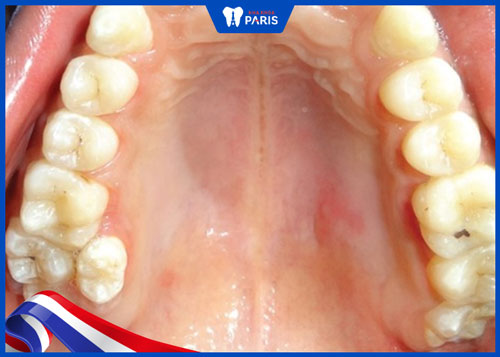 Răng mọc thừa ở hàm trên