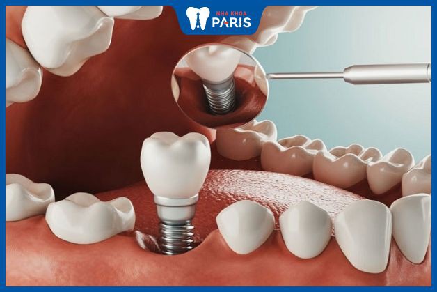 Implant có thể thay thế hoàn toàn răng 6 thật