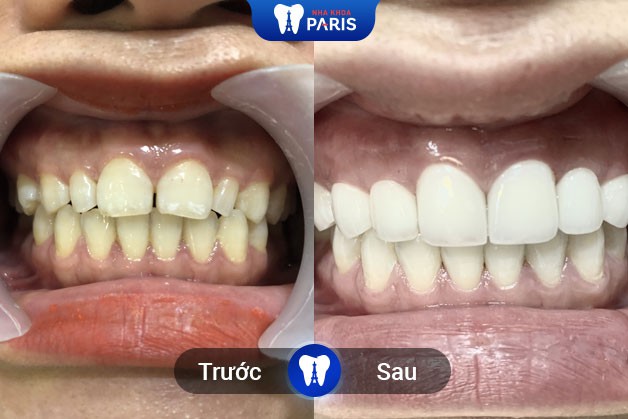 Trước và sau khi bọc 16 răng sứ