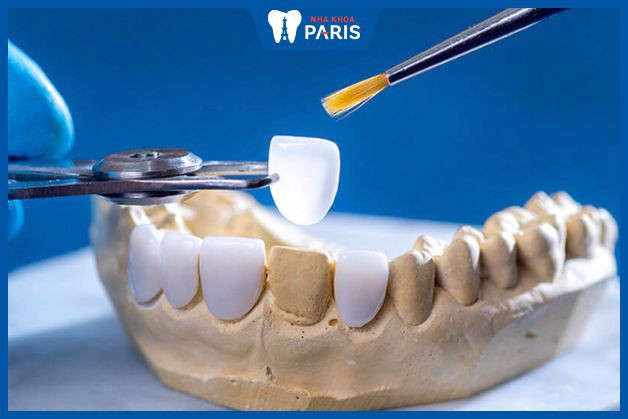 Hiểu rõ về kỹ thuật dán răng sứ thẩm mỹ