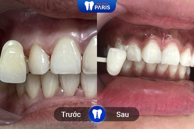 Tẩy trắng giúp răng chắc khỏe và đẹp lâu dài