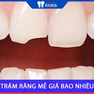 Trám răng MẺ giá bao nhiêu tiền? Các yếu tố ảnh hưởng tới chi phí