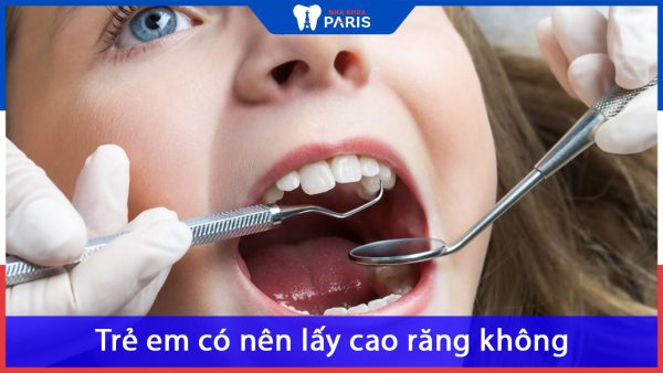 Trẻ em có nên lấy cao răng không? Khi nào nên cạo vôi răng cho trẻ?
