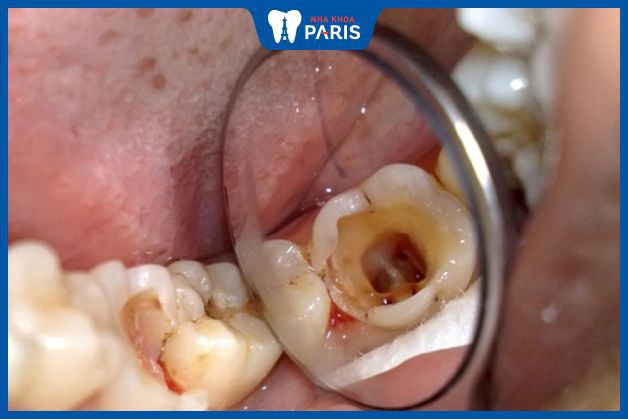 Vỡ răng là 1 biểu hiện khi bị sâu nặng