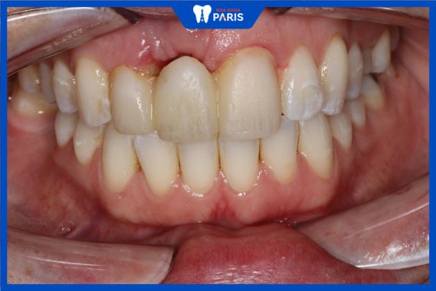 Răng giả không hạn chế được tình trạng mất xương