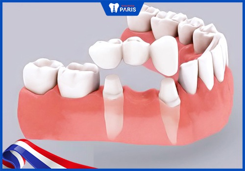 cầu răng sứ khắc phục tình trạng mất 1 răng