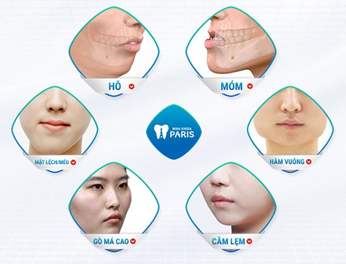 Phẫu thuật khắc phục hô móm lệch hiệu quả