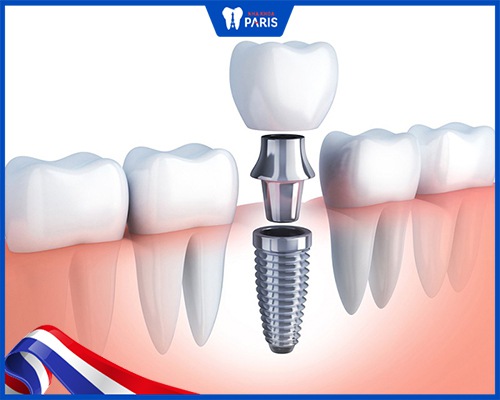 trồng răng implant khắc phục mất 1 răng